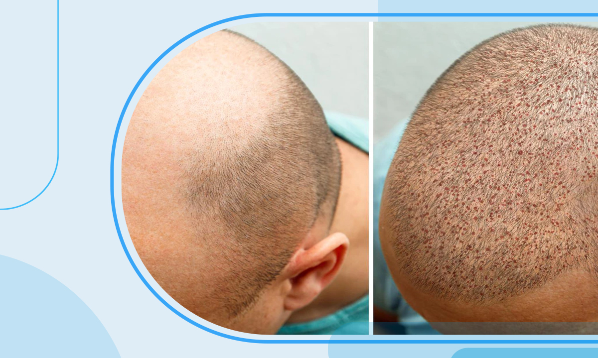 Stem Cell Hair Transplant ‣ Frequently Asked Questions